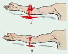 Виды кровотечения: 