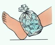 Полиэтиленовый пакет со льдом, наложенный на голеностопный сустав при растяжении связок