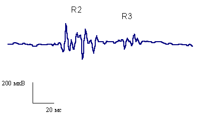 Ноцицептивный флексорный рефлекс. Nociceptive flexion reflex